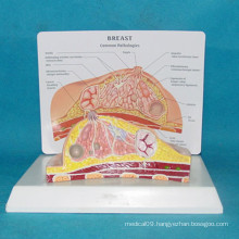 High Quality Pathological Women Breast Anatomic Medical Model (R150105)